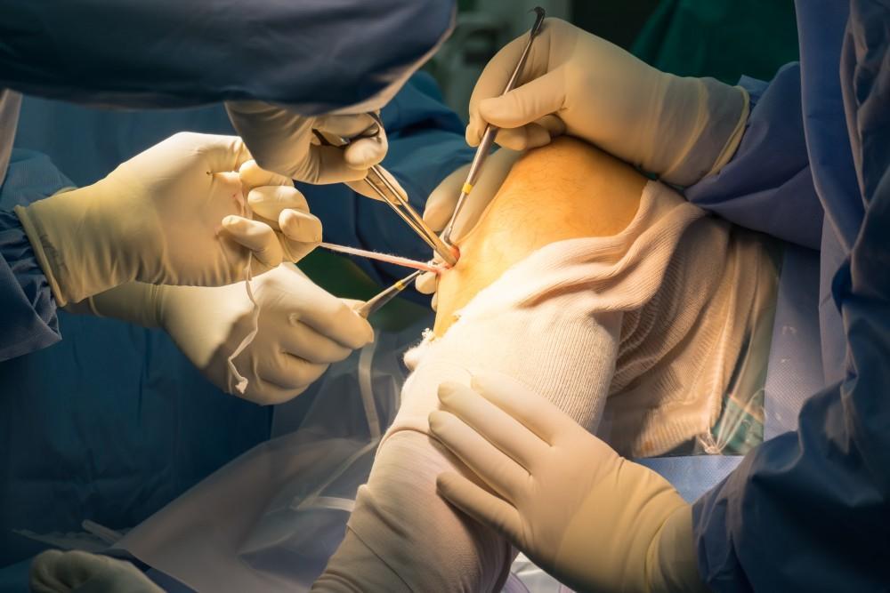 Top 14 Benefits of Choosing a Minimally Invasive Laparoscopic Surgeon