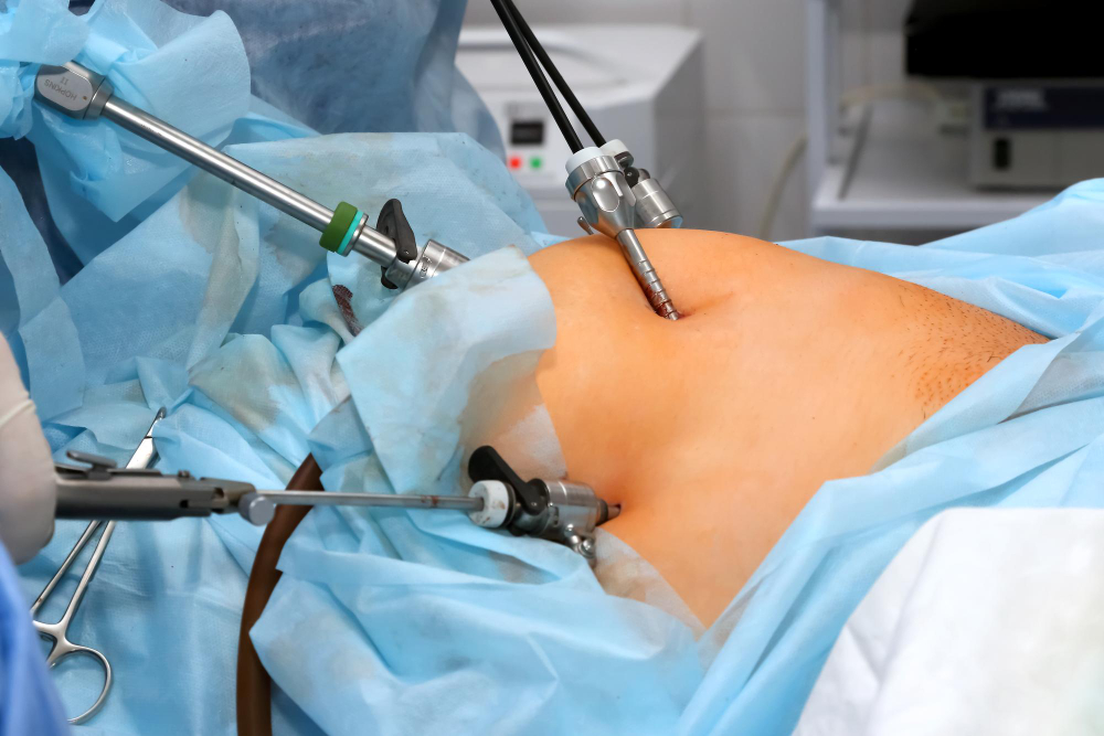 Appendix Surgery